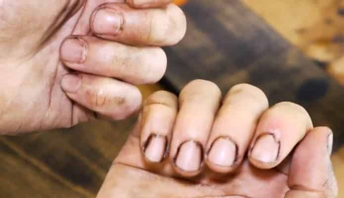 How to Get Wood Stain off Skin